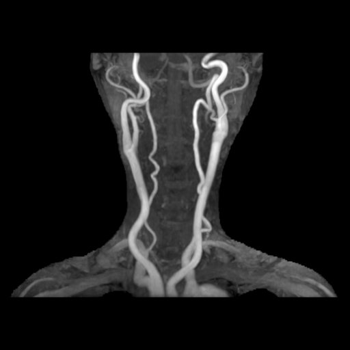 頚部3D-MRA